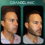 نتائج قبل وبعد زراعة الذقن في Grand Clinic، تحسين تحديد وكونتور الذقن