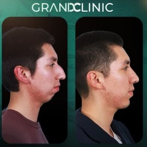 before-after photo mentoplastika-plastika-podborodka
