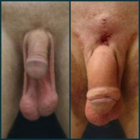 before-after photo penile-implant-surgery