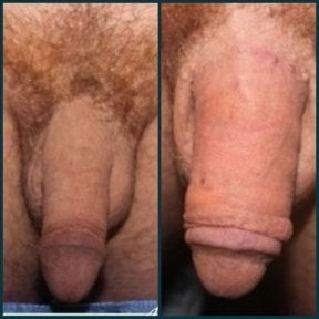 before-after photo penile-implant-surgery