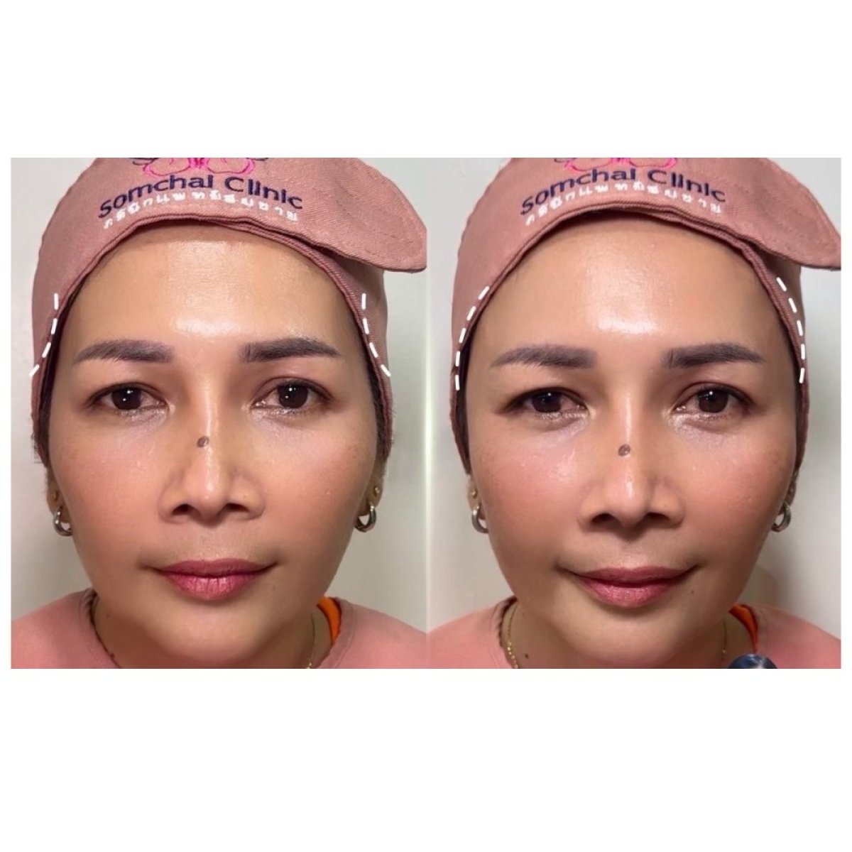 Resultados antes y después de rellenos en Somchai Clinic, mayor volumen y contorno facial