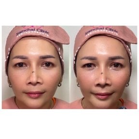 Результат до и после инъекций филлеров в Somchai Clinic, улучшение объема лица