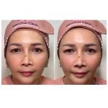 Результат до и после инъекций филлеров в Somchai Clinic, улучшение объема лица
