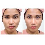 Before and after fillers injection at Somchai Clinic, facial contouring visible result