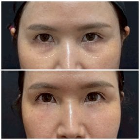 Before and after fillers injection under eyes at Somchai Clinic, visible reduction of dark circles
