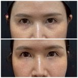 Before and after fillers injection under eyes at Somchai Clinic, visible reduction of dark circles