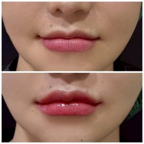 Before and after lip fillers injection result at Somchai Clinic, enhanced lip volume and shape