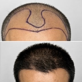 Résultats avant et après greffe de cheveux à la Somchai Clinic, ligne capillaire restaurée