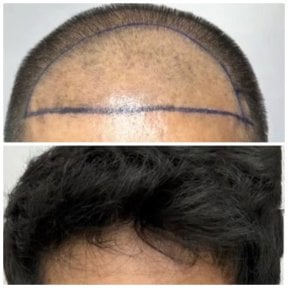 Résultat avant et après greffe de cheveux à la Somchai Clinic – ligne capillaire restaurée