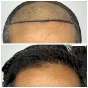 Before and after hair transplant result at Somchai Clinic – restored natural hairline
