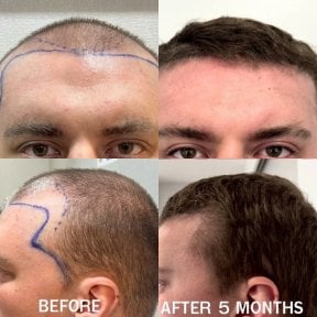 before-after photo hair-transplant