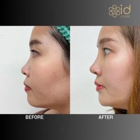 before-after photo rhinoplasty-nose-job