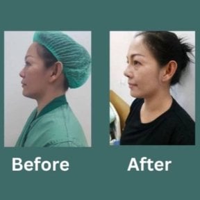 before-after photo rhinoplasty-nose-job