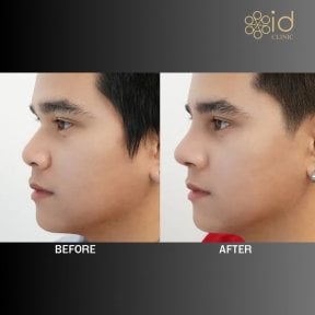 before-after photo rhinoplasty-nose-job