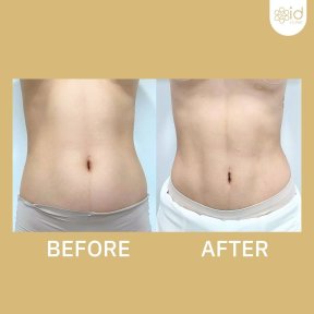 before-after photo abdominal-liposuction