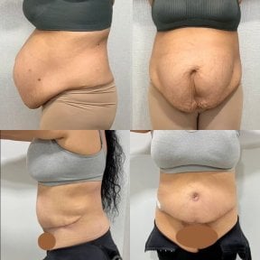 before-after photo abdominoplasty
