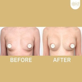 before-after photo breast-augmentation