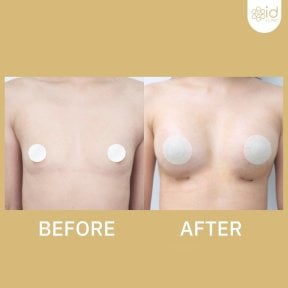 before-after photo breast-augmentation