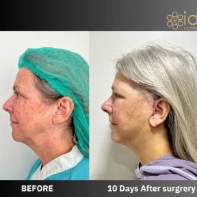 before-after photo endoscopic-facelift