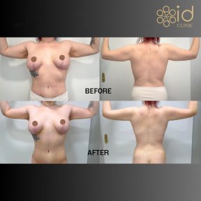 before-after photo vaser-liposuction