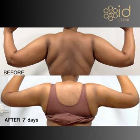 before-after photo vaser-liposuction