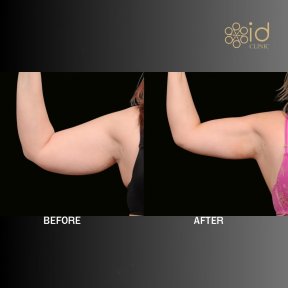before-after photo vaser-liposuction