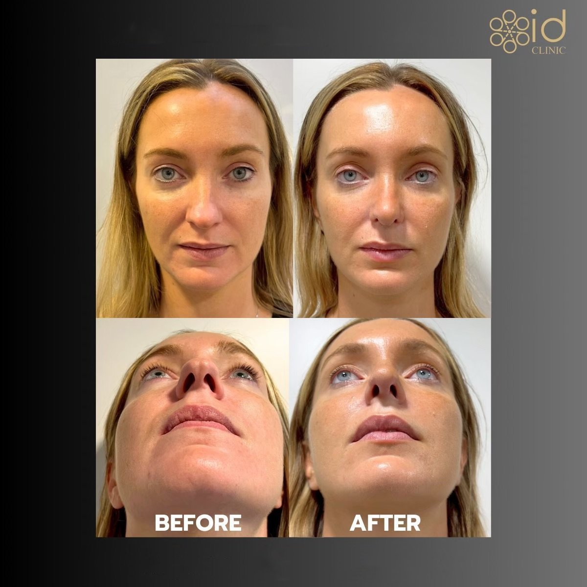Resultados antes y después de rinoplastia de punta en ID Clinic Bangkok, mejora de la forma