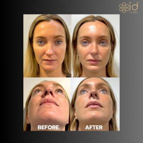 before-after photo tip-rhinoplasty