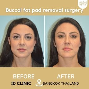 before-after photo neck-lift