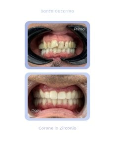 Antes y después de coronas de zirconio en Santa Caterina Clinic Dental & Aesthetic Medicine, resultado sonrisa