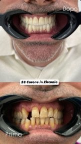 Resultado antes y después de coronas de zirconio en Santa Caterina Clinic Dental & Aesthetic Medicine