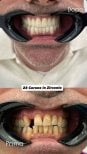Resultado antes y después de coronas de zirconio en Santa Caterina Clinic Dental & Aesthetic Medicine