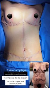 before-after photo mastopexy-breast-lift-contour-plastics