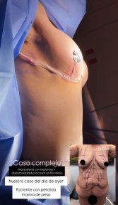 before-after photo mastopexy-breast-lift-contour-plastics