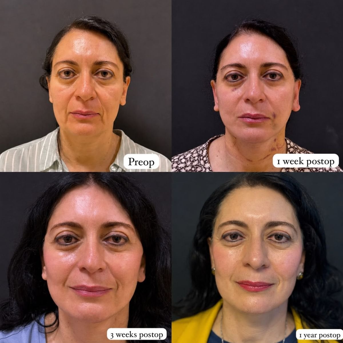 Deep plane facelift before and after results at Lucio Santos Plastic Surgery, facial rejuvenation