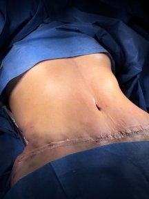 before-after photo liposuction