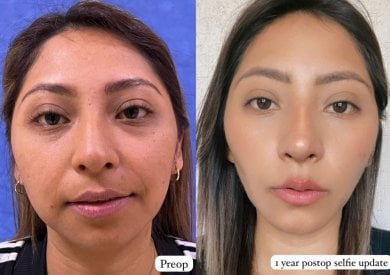 before-after photo deep-plane-facelift