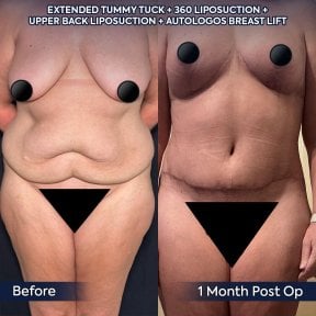 Efekty przed i po plastyce brzucha, liposukcji i liftingu piersi w Dr. Safa Manav Clinic