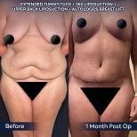 Efekty przed i po plastyce brzucha, liposukcji i liftingu piersi w Dr. Safa Manav Clinic