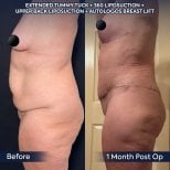 Efekty przed i po plastyce brzucha i liposukcji w Dr. Safa Manav Clinic, modelowanie sylwetki