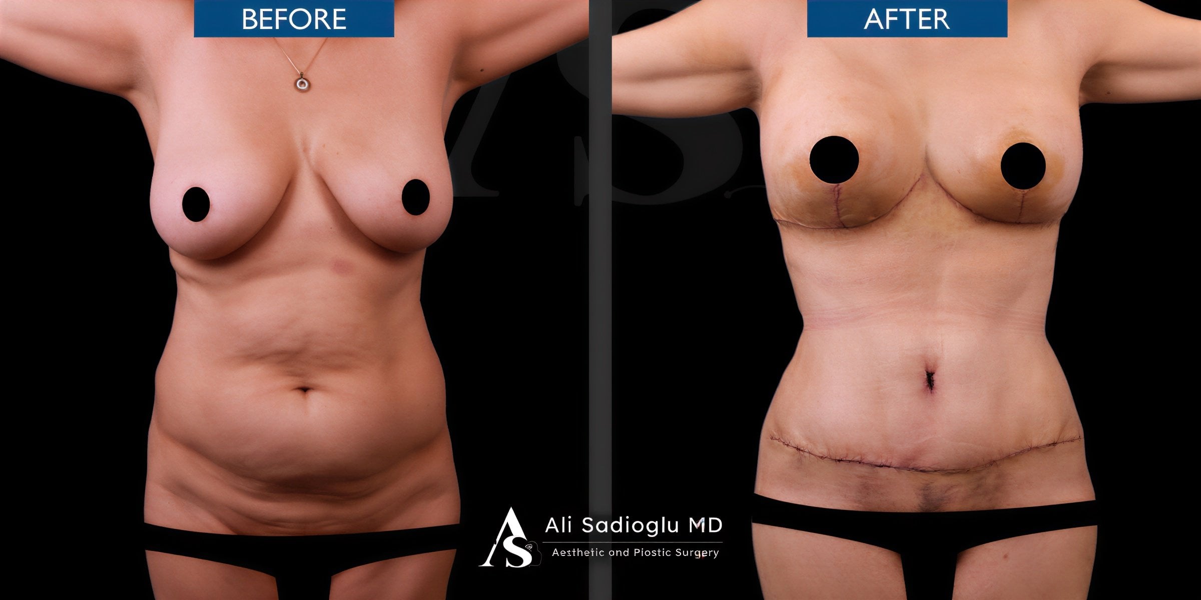 Resultados de abdominoplastia antes y después en Dr. Safa Manav Clinic, abdomen definido
