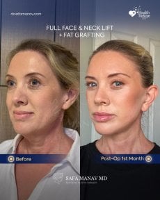 before-after photo deep-plane-facelift