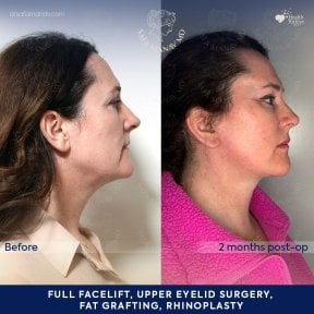 before-after photo deep-plane-facelift