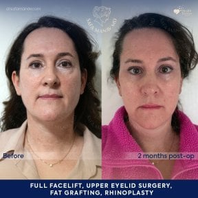 before-after photo deep-plane-facelift
