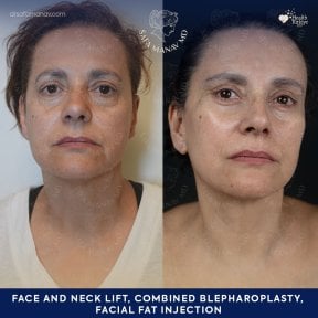 before-after photo deep-plane-facelift