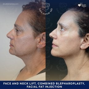 before-after photo deep-plane-facelift