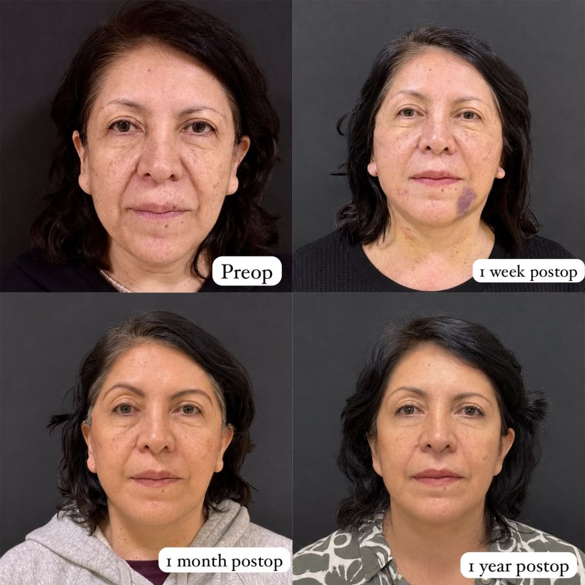 Deep plane facelift before and after results at Lucio Santos Plastic Surgery, facial rejuvenation