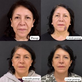 before-after photo deep-plane-facelift