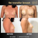 Before and after fat transfer breast augmentation results at ID Clinic Bangkok, natural contour