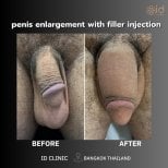 Before and after penis enlargement with filler injection results at ID Clinic Bangkok